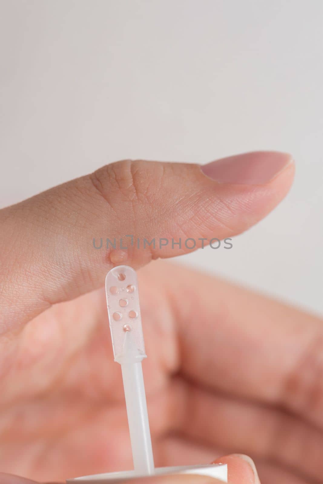 Wart treatment process. The doctor applies the medicine with a special spatula to the wart. Getting rid of a benign formation on human skin by using a medicine