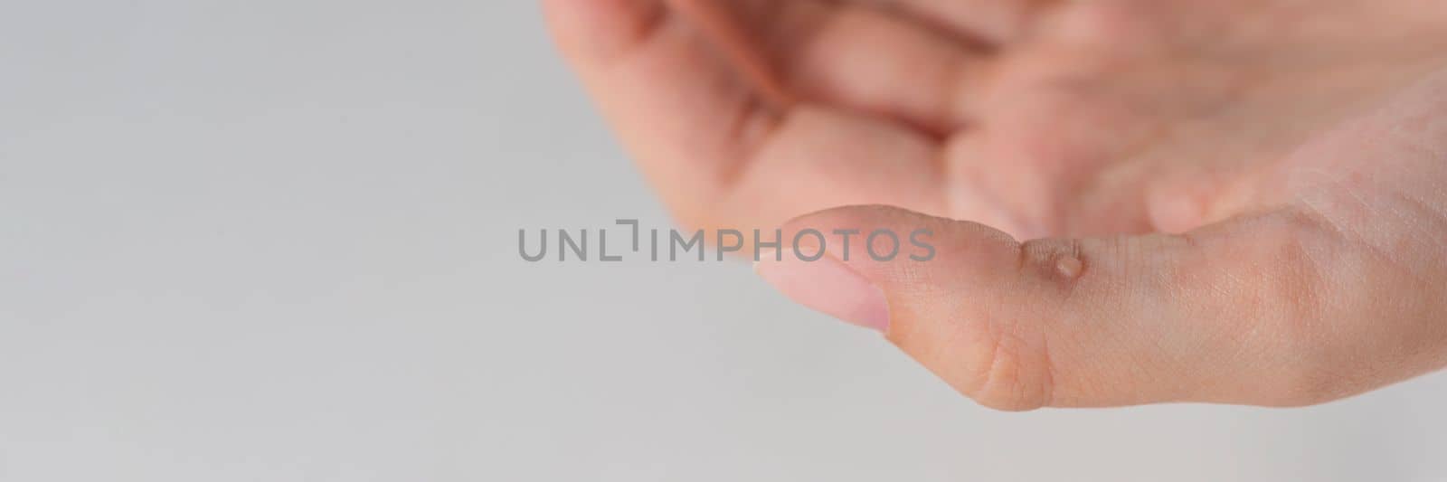 Wart on hand. The concept of treating warts and other skin defects. Close-up of a wart on a finger, a benign growth on human skin. by SERSOL