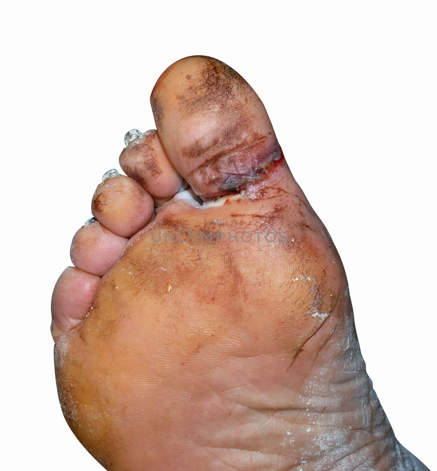 A large laceration between the big toe and the foot.