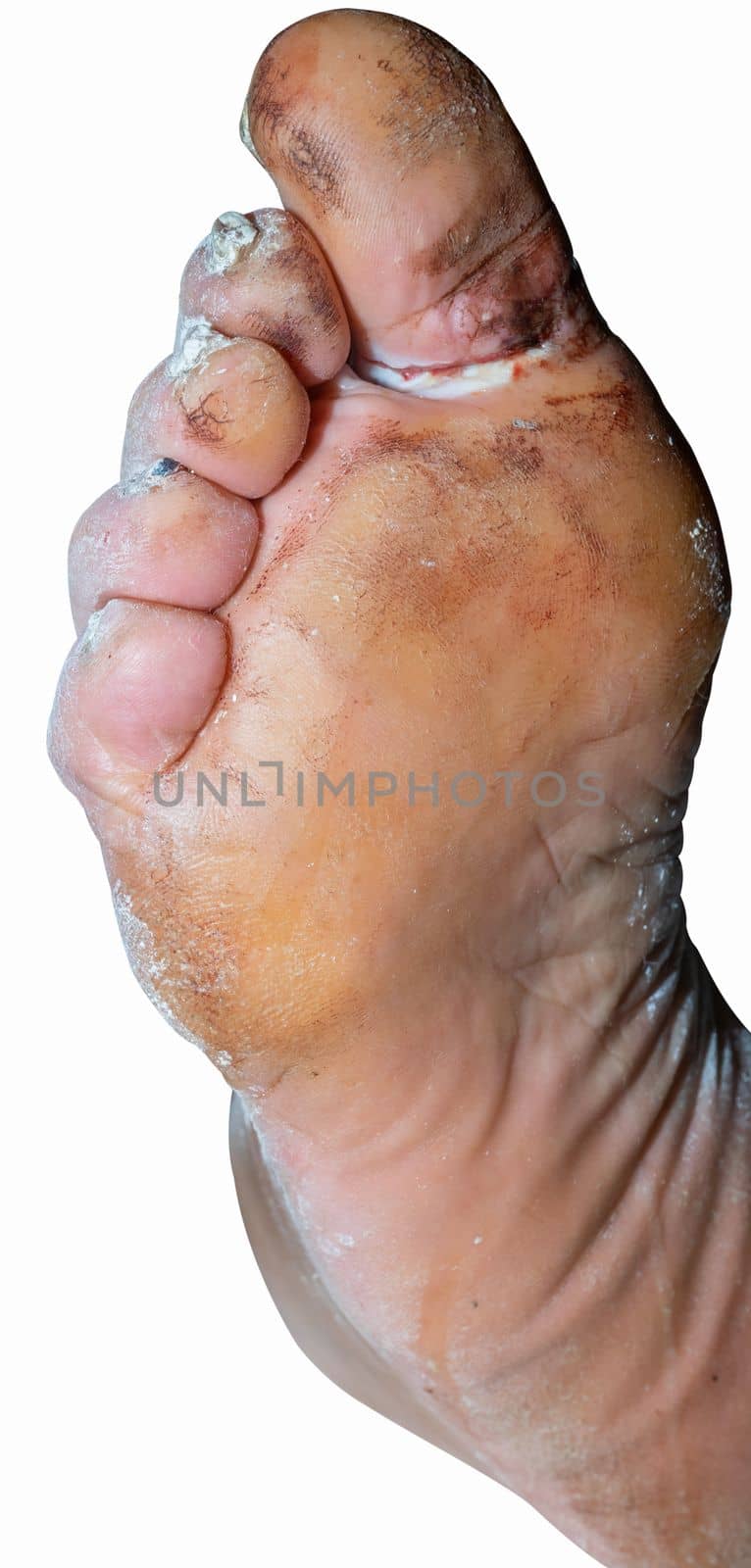 Injured foot of an elderly man on a white background.