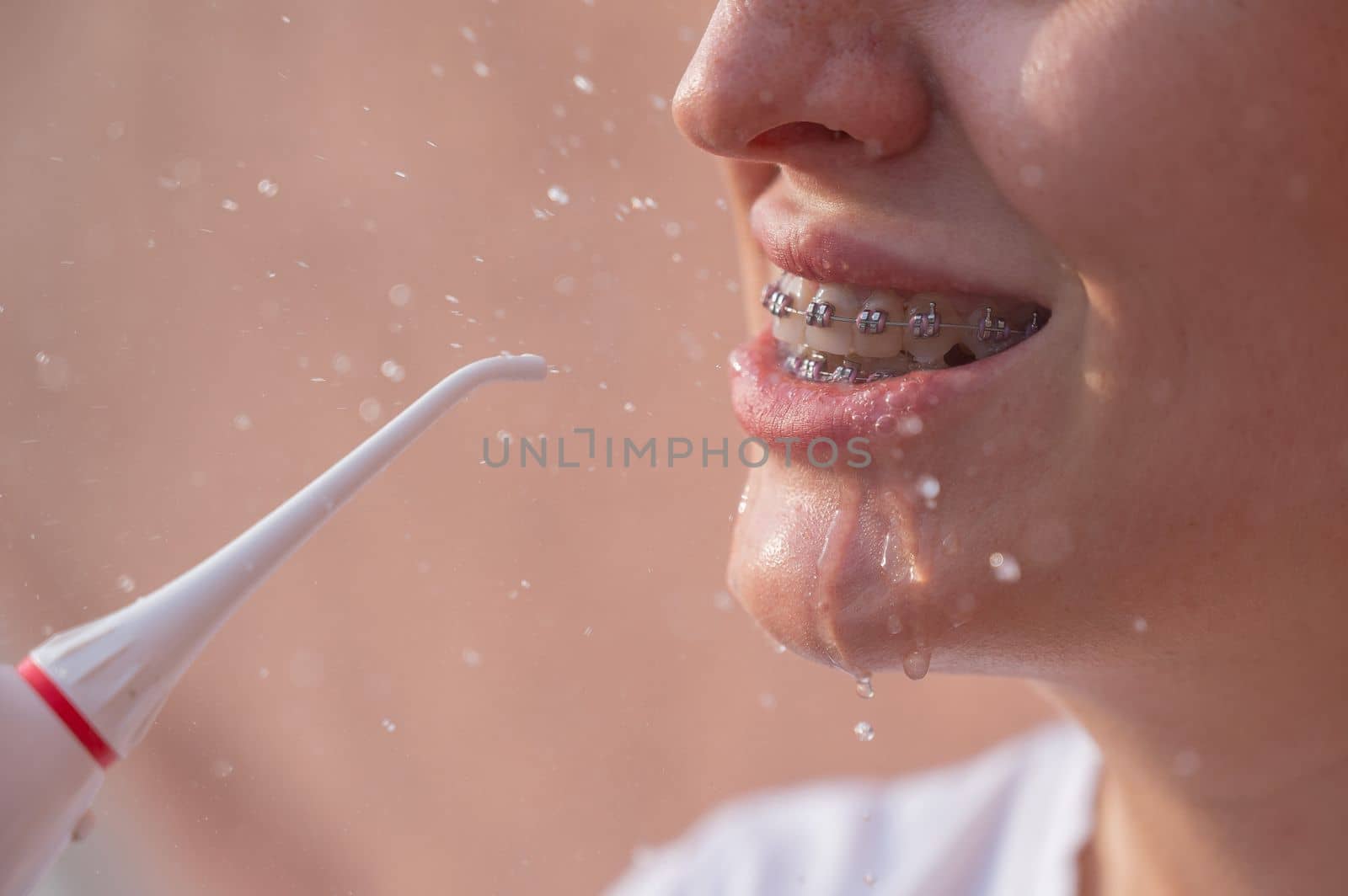 A woman with braces on her teeth uses an irrigator. Close-up portrait