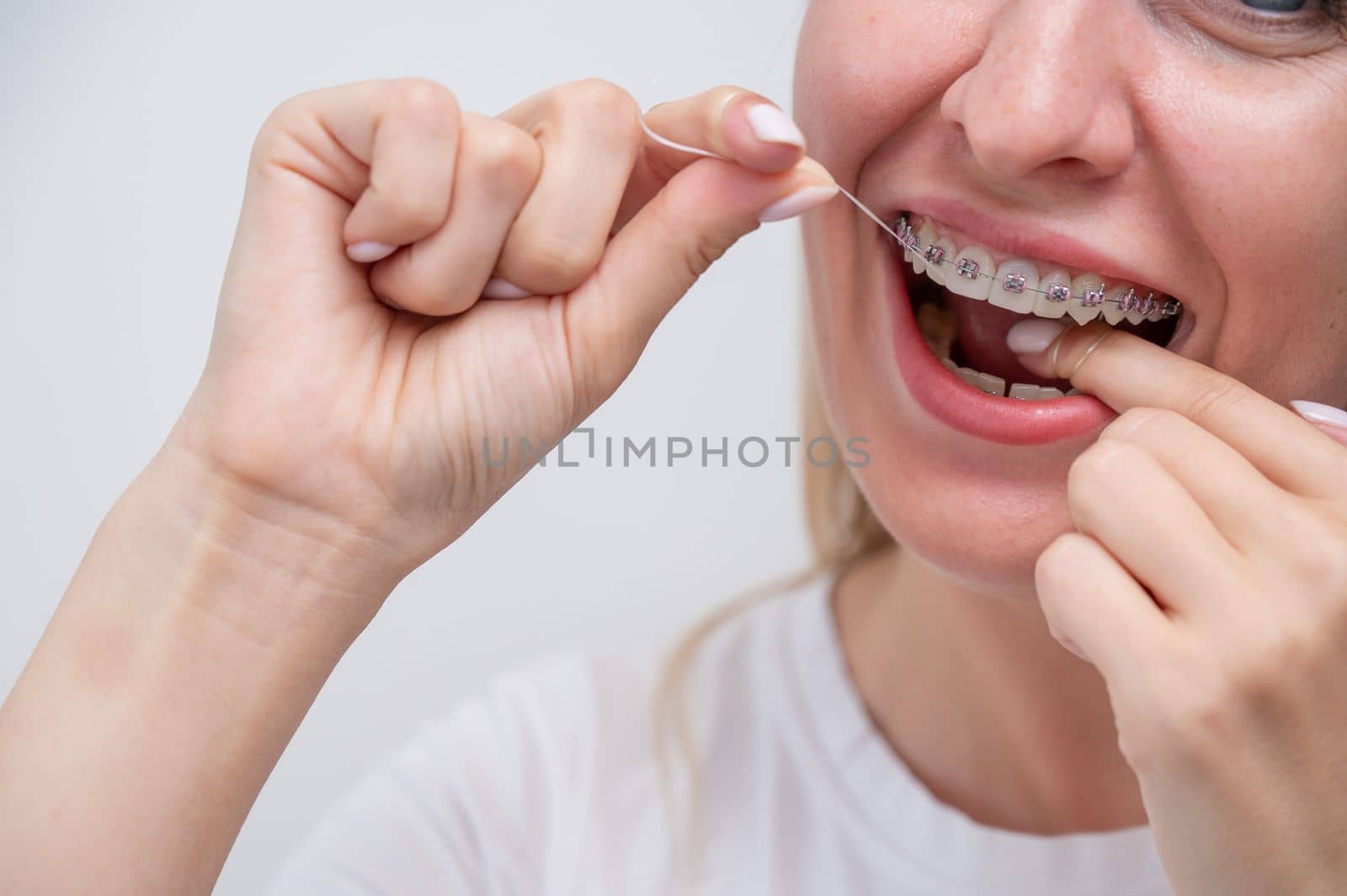 Caucasian woman cleaning her teeth with braces using dental floss. by mrwed54