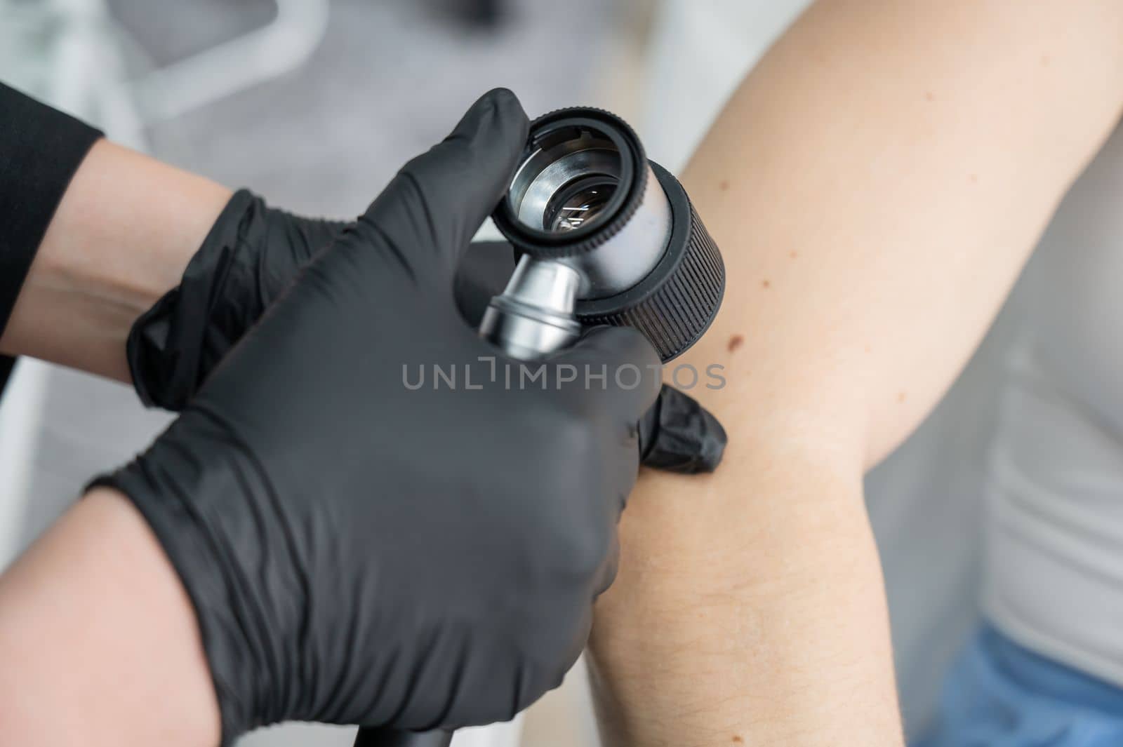 A dermatologist examines a patient's mole through a dermatoscope