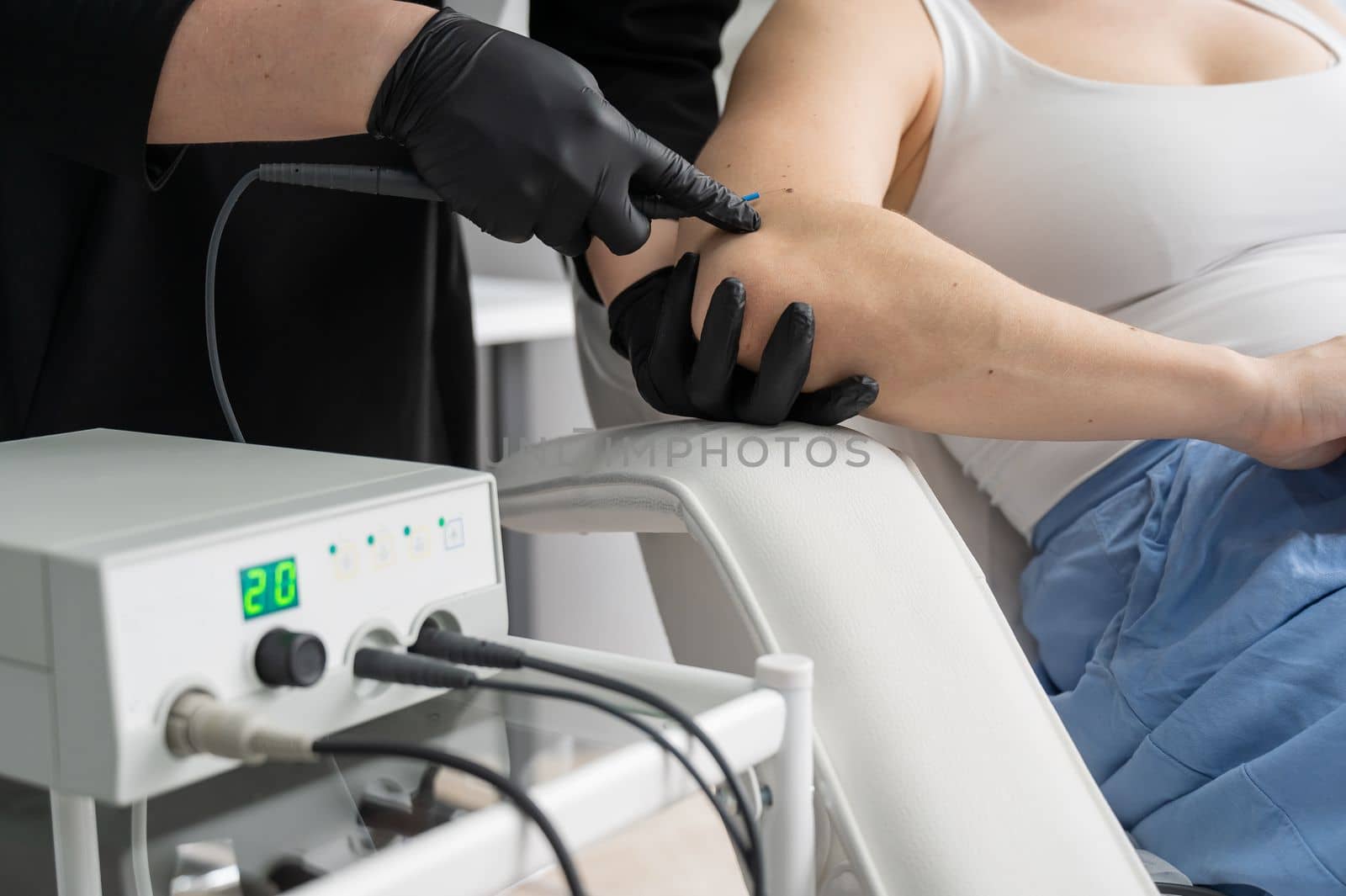 Dermatologist removes a mole on a patient's arm using an electrocoagulator
