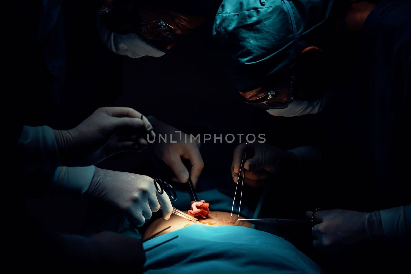 Surgical team performing surgery to patient in sterile operating room. In a surgery room lit by a lamp, a professional and confident surgical team provides medical care to an unconscious patient.