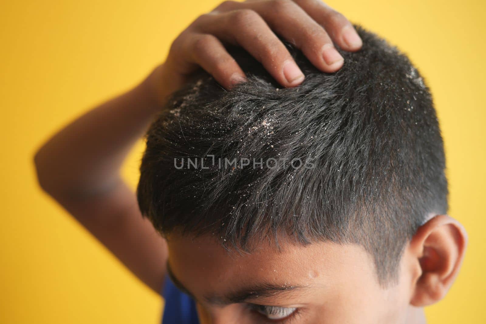 men with dandruff in his hair, closeup .