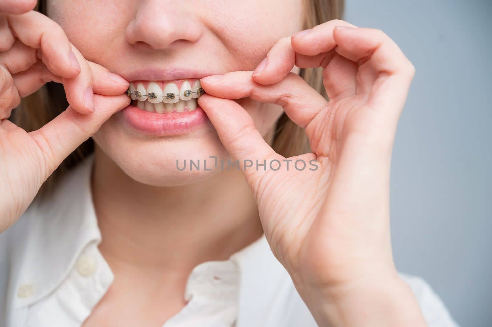 Close-up portrait of a red-haired girl touching braces. Young woman corrects bite with orthodontic appliance