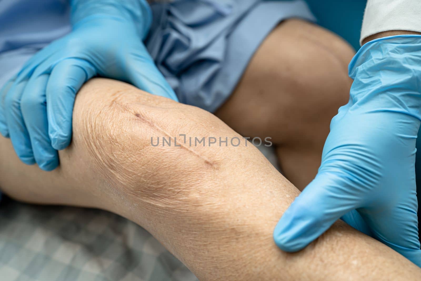 Asian senior or elderly old lady woman patient show her scars surgical total knee joint replacement Suture wound surgery arthroplasty on bed in nursing hospital ward, healthy strong medical concept. by pamai