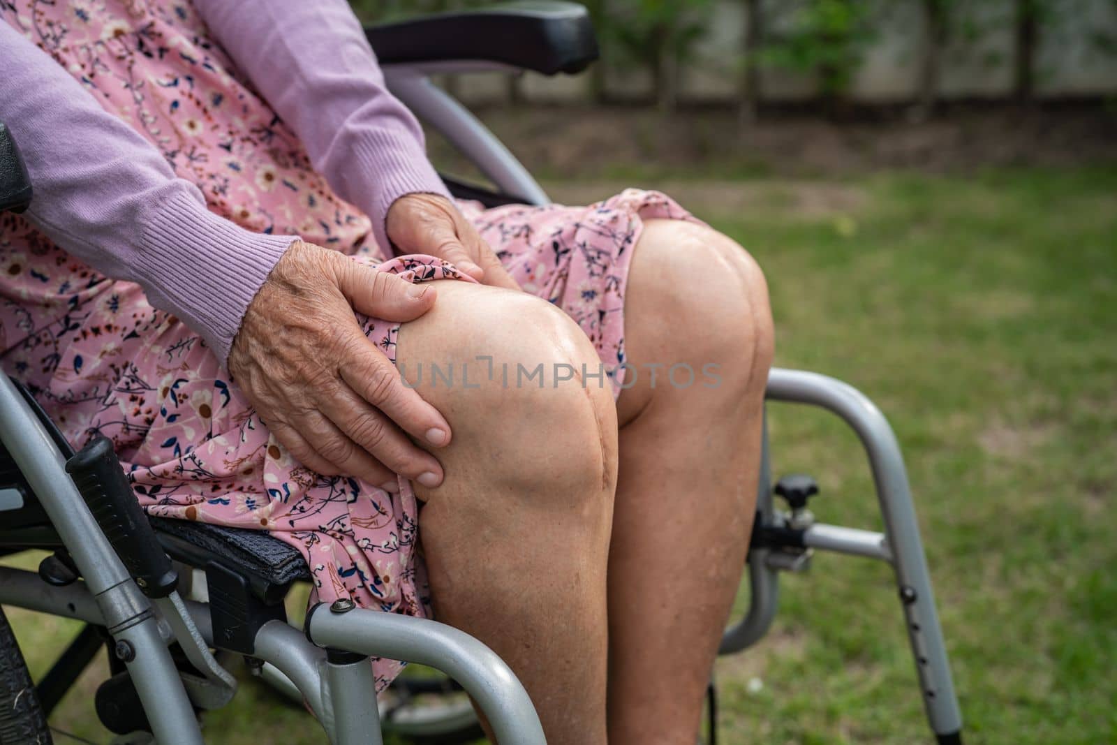 Asian senior or elderly old lady woman patient show her scars surgical total knee joint replacement Suture wound surgery arthroplasty on bed in nursing hospital ward, healthy strong medical concept.