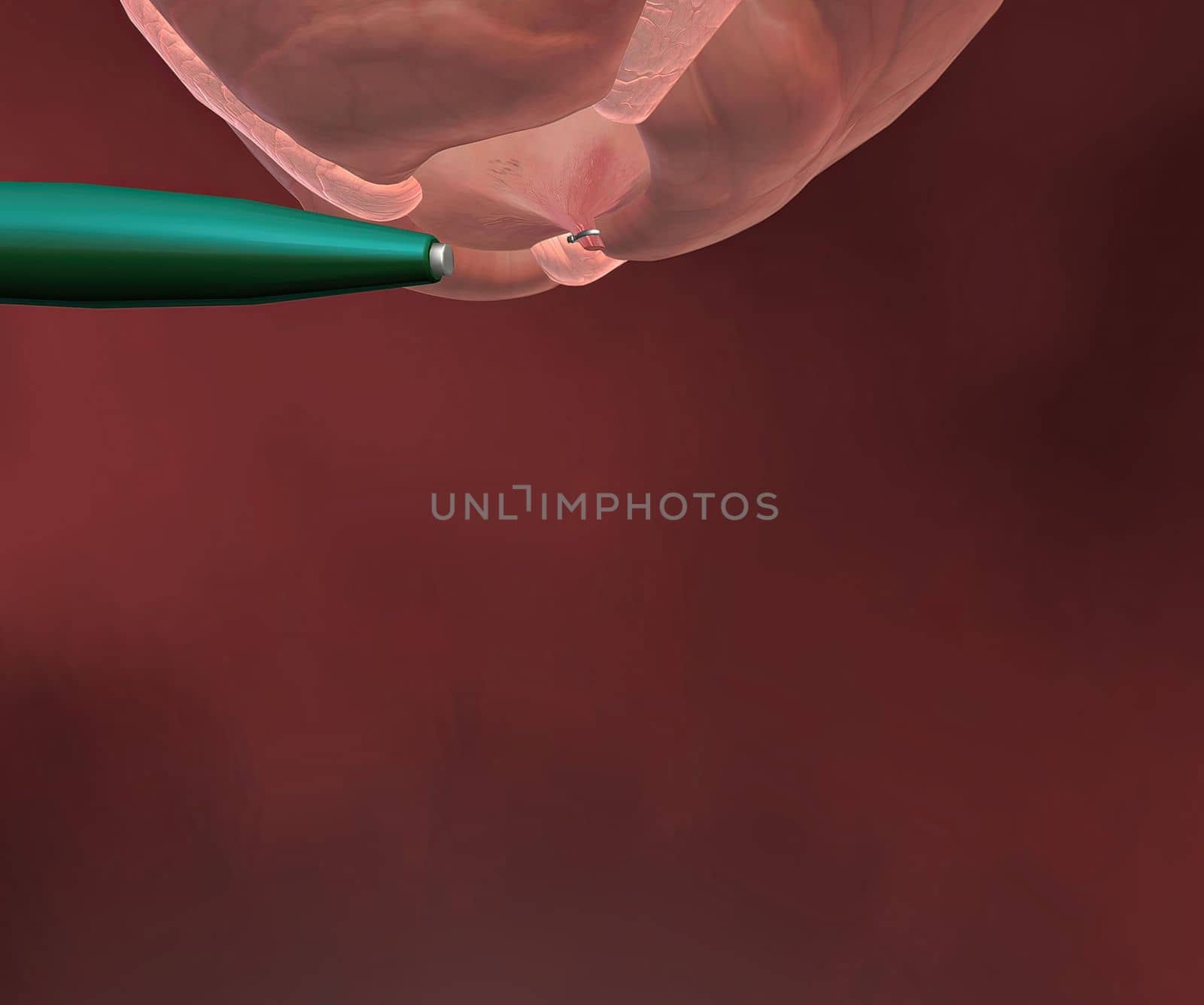 Appendicitis is inflammation of the appendix, a finger-shaped sac protruding from your colon on the lower right side of your abdomen. by creativepic