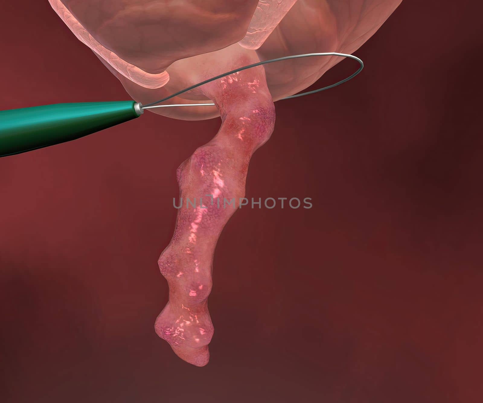 Appendicitis is inflammation of the appendix, a finger-shaped sac protruding from your colon on the lower right side of your abdomen. by creativepic