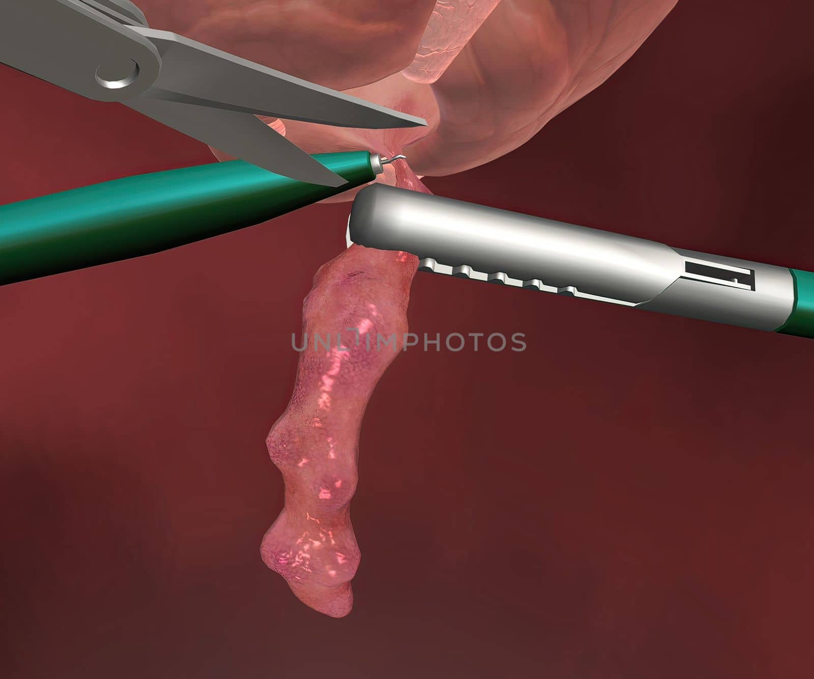 Appendicitis is inflammation of the appendix, a finger-shaped sac protruding from your colon on the lower right side of your abdomen. by creativepic