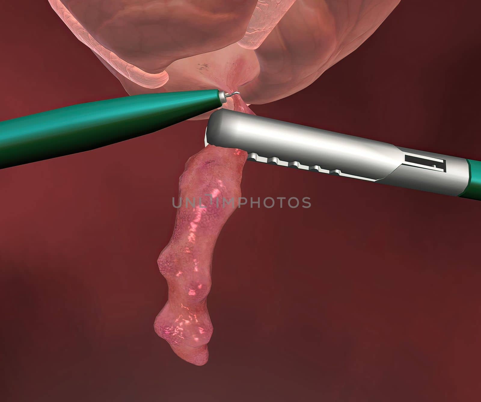 Appendicitis is inflammation of the appendix, a finger-shaped sac protruding from your colon on the lower right side of your abdomen. by creativepic