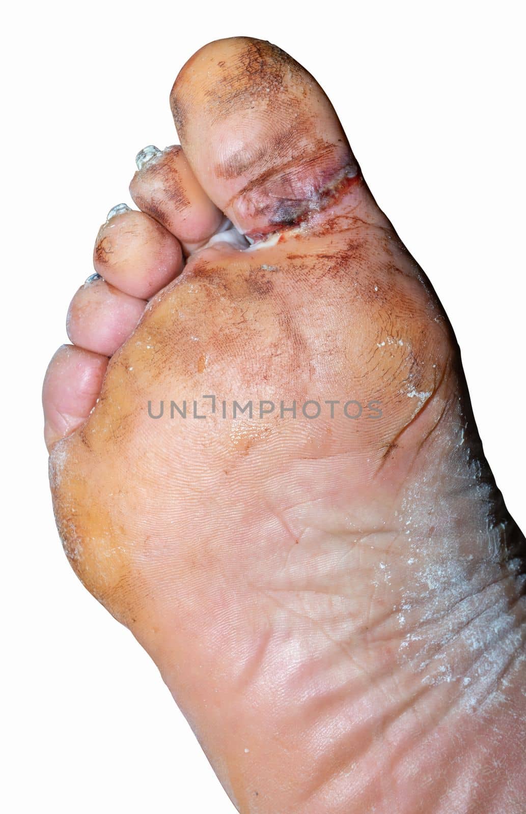 A large laceration between the big toe and the foot.