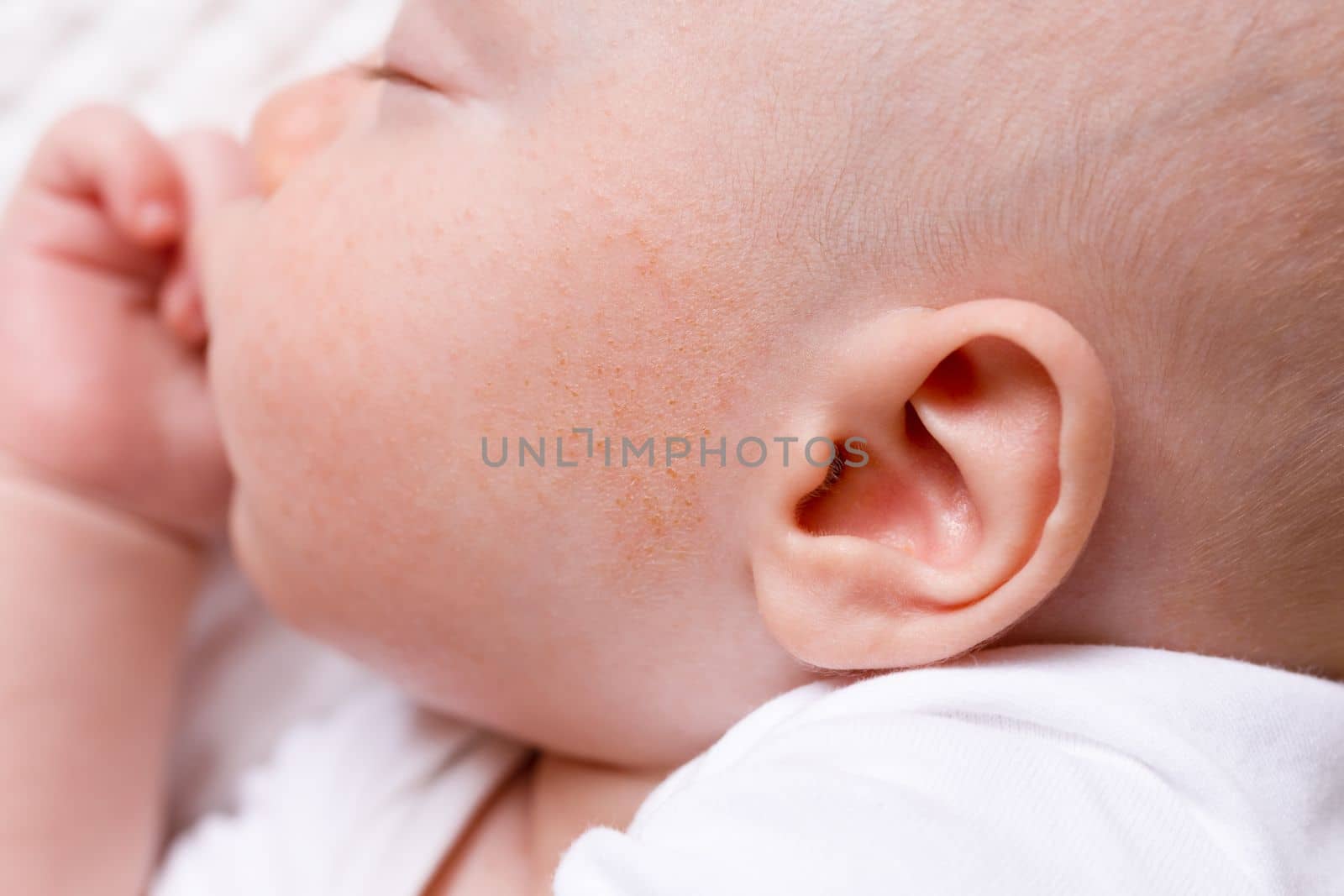 baby infant dermatitis allergic skin by Kondrateva