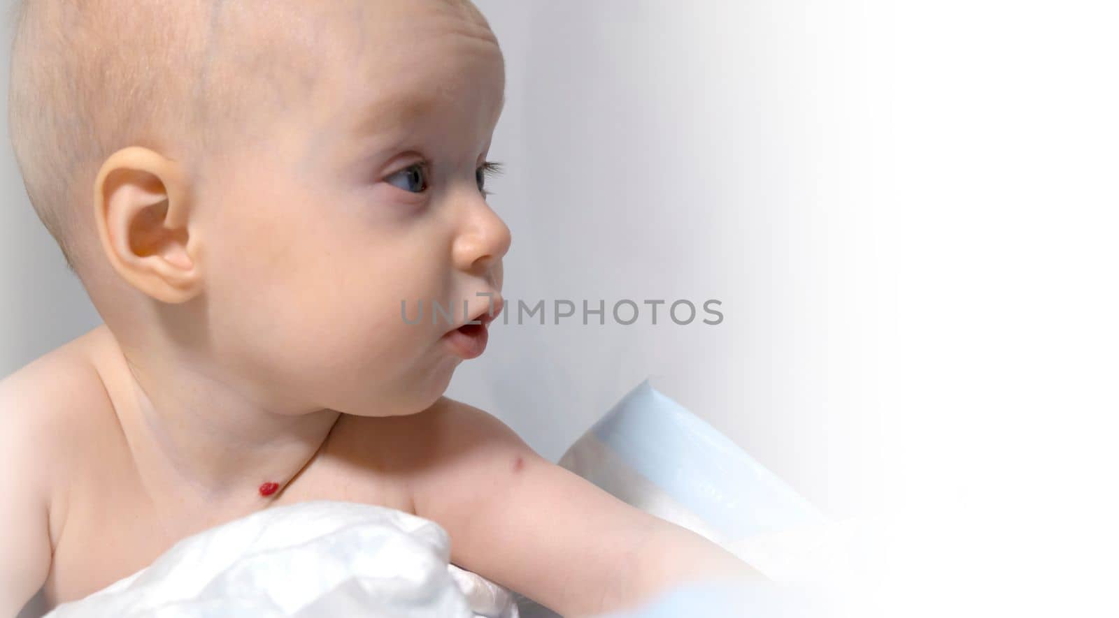 a baby with a hemangioma on his neck lies on a white background. banner with a copy space. profile of a little bald baby girl. the kid looks to the side