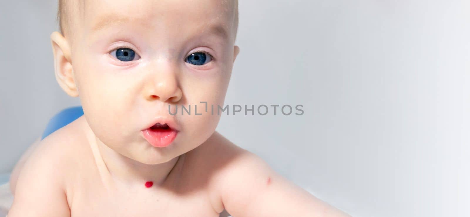 a baby with a hemangioma on his neck lies on a white background. banner with a copy space. profile of a little bald baby girl. the kid looks to the side