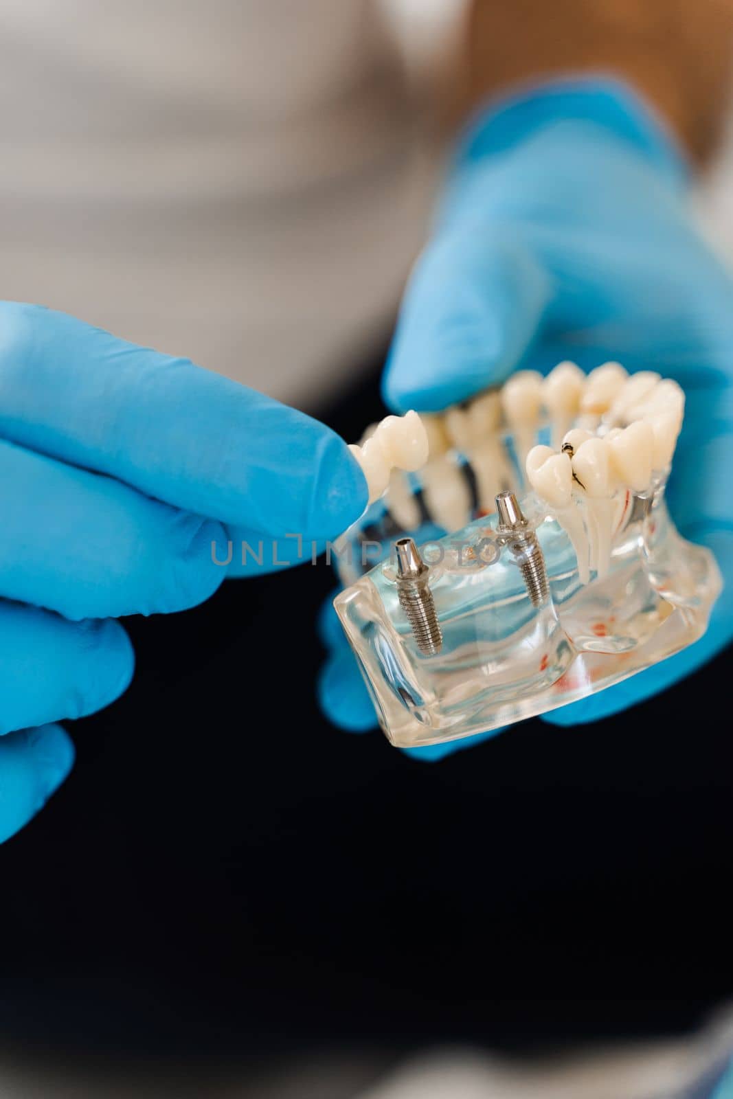 Artificial plastic jaw with dental implants close-up. Dental prosthetics and implants. Dental prosthetics consultation with dentist for patient woman in dentistry. by Rabizo