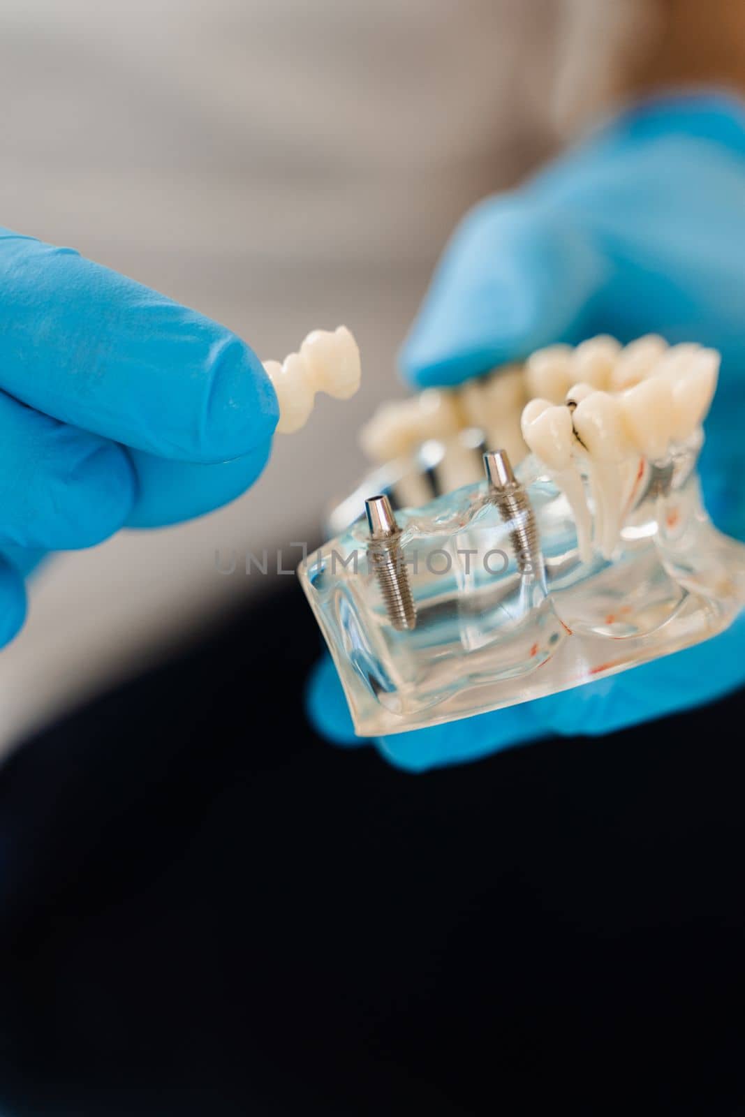 Artificial plastic jaw with dental implants close-up. Dental prosthetics and implants. Dental prosthetics consultation with dentist for patient woman in dentistry