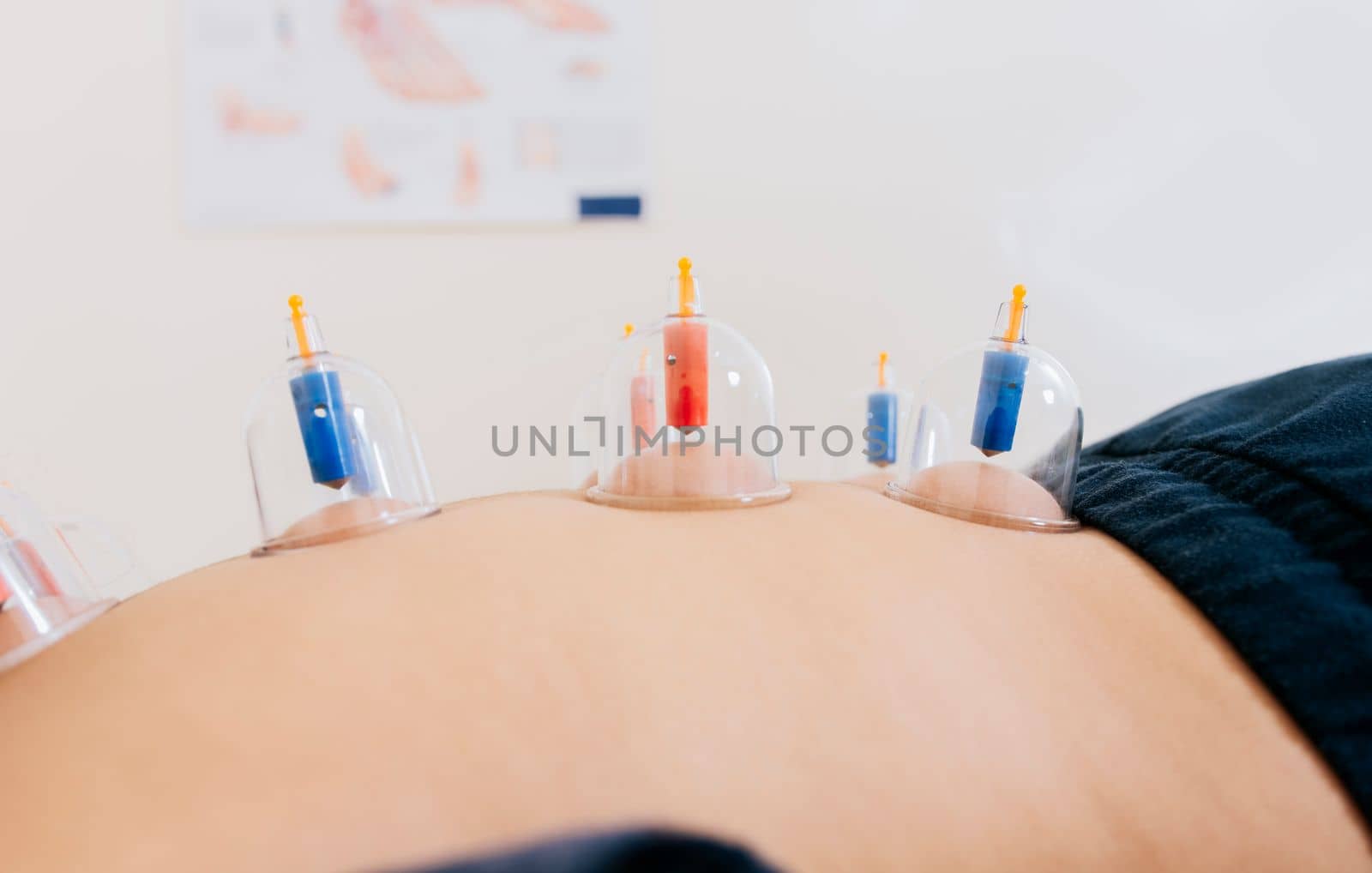 Close-up of suction cups on the patient back, Acupuncture cupping on the back of a person lying down. Patient lying down with suction cups on her back. Physiotherapy cupping on a lying patient by isaiphoto