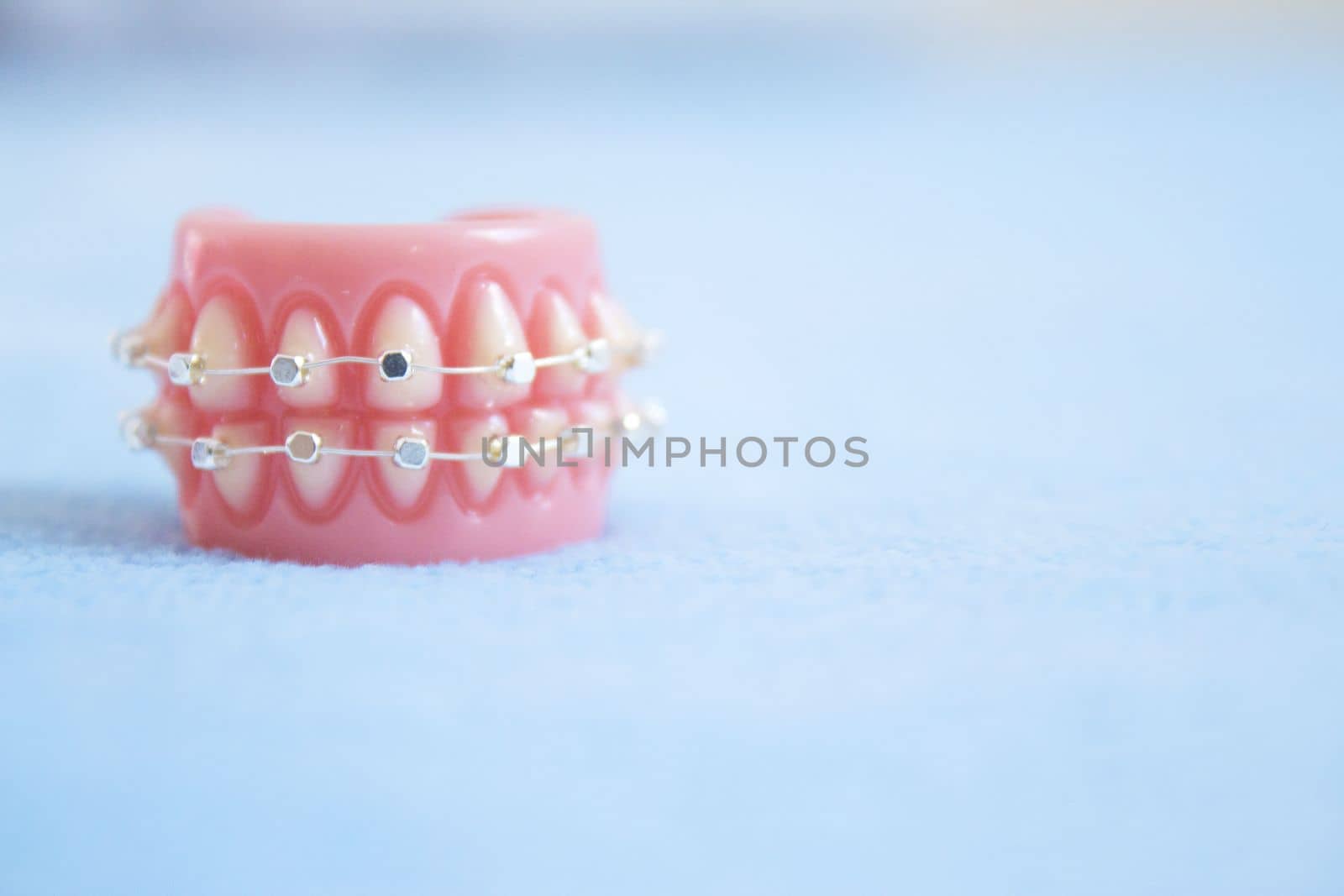 Metal orthodontic denture base by GemaIbarra