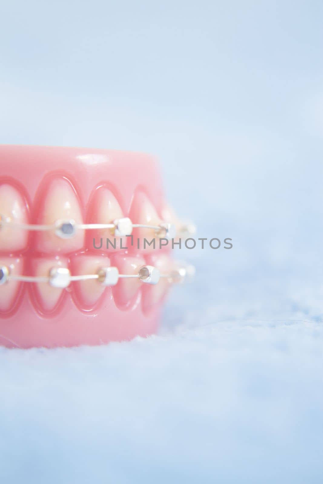 Metal orthodontic denture base by GemaIbarra