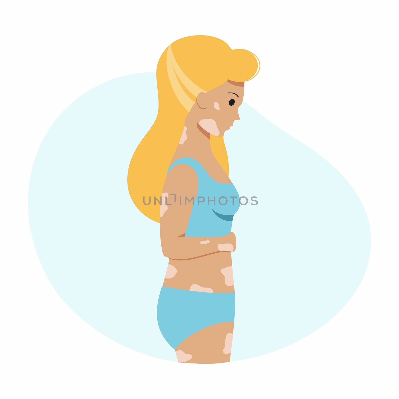 A girl with vitiligo on her skin. A woman with a pigmentation spot and a swimsuit. Vector character in a flat style . by polinka_art