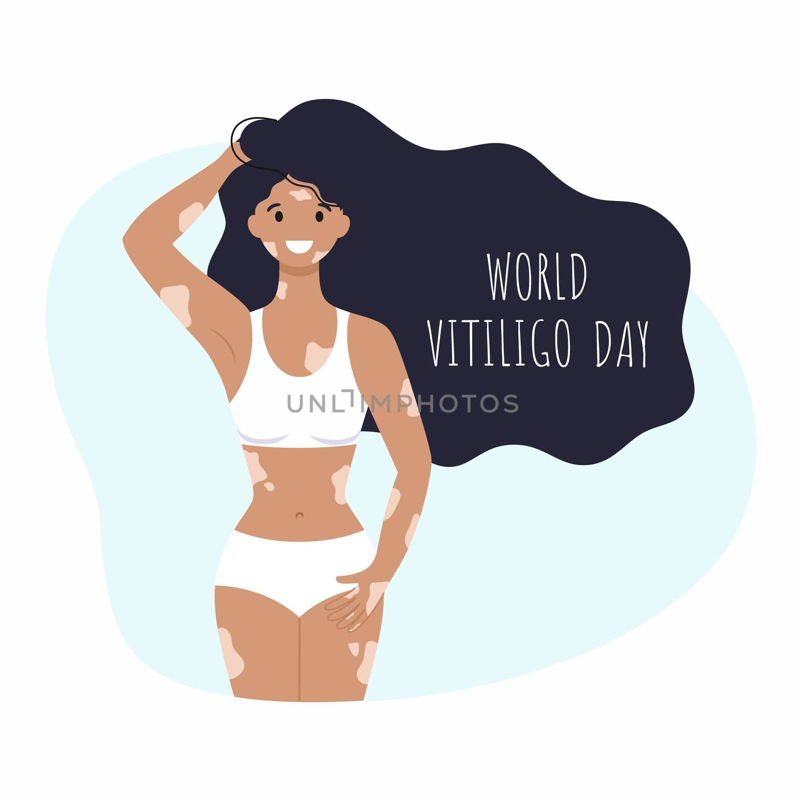 Beautiful girl in a swimsuit and with vitiligo. The inscription world vitiligo day on June 25. A woman has vitiligo. Vector illustration on the topic of rare diseases. by polinka_art