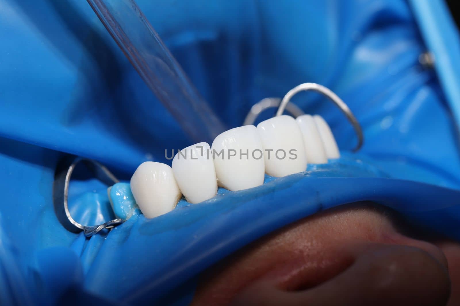 Teeth of patient with veneers being treated by dentist closeup by kuprevich