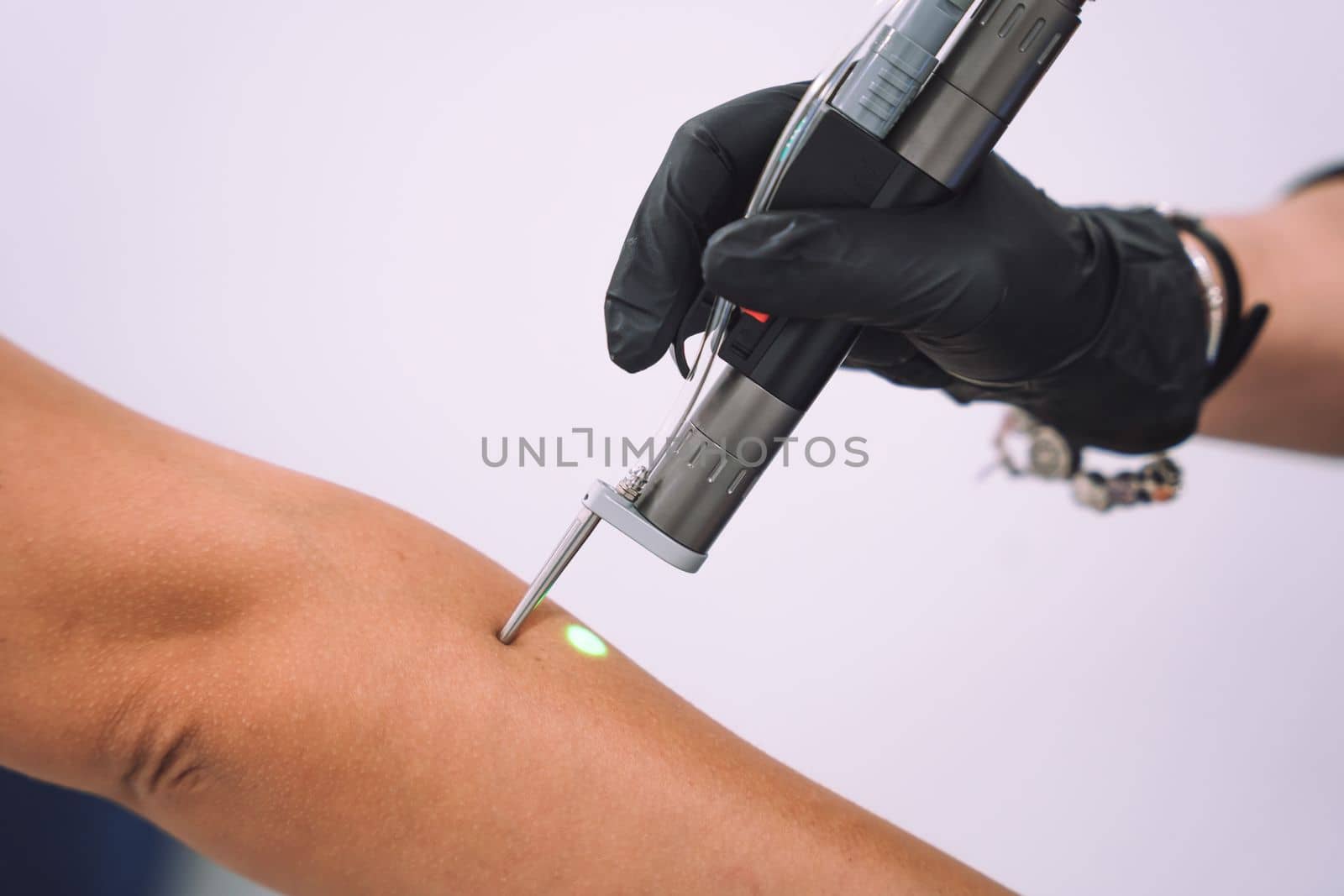 Close up shot of gloved hand with the laser hair removal machine's handpiece along woman hand. Alexandrite laser techhnology removing hair. Beauty procedureBeauty technology concept