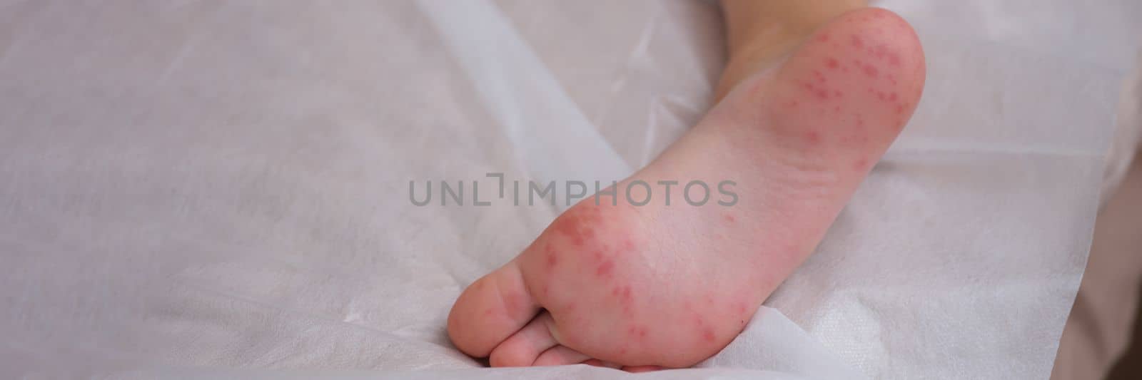 Child foot with red itchy rash closeup. Viral exanthema symptom hand-foot-mouth concept