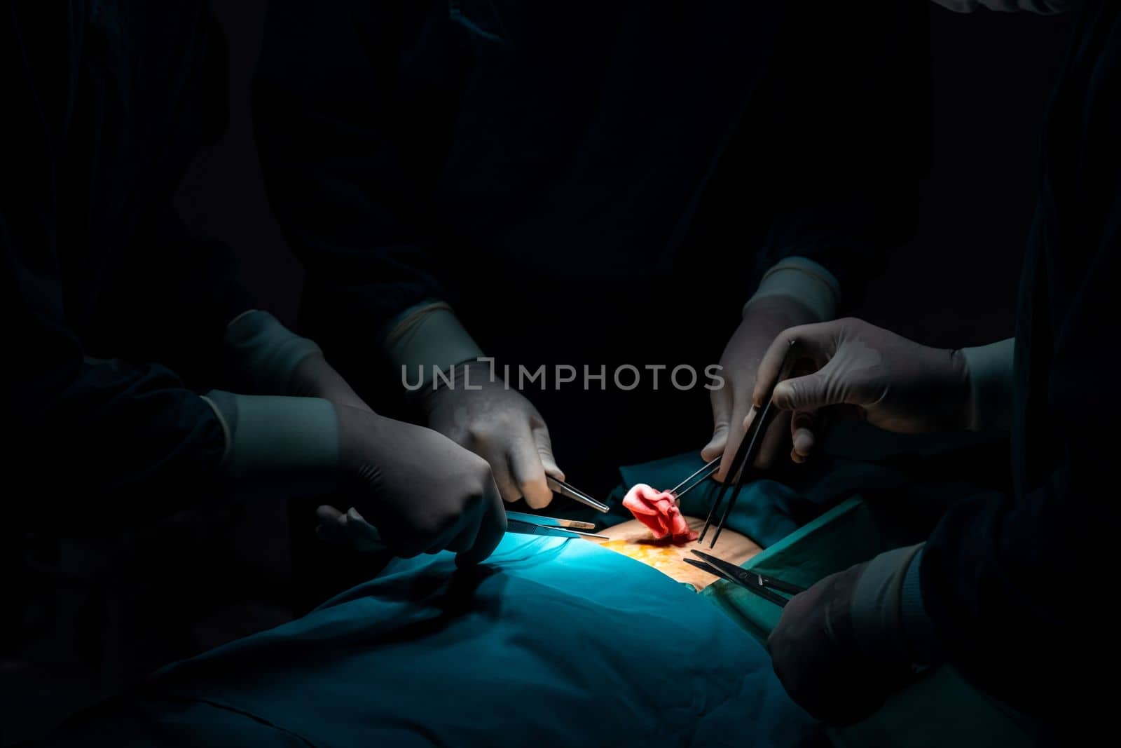 Surgical team performing surgery to patient in sterile operating room. In a surgery room lit by a lamp, a professional and confident surgical team provides medical care to an unconscious patient.