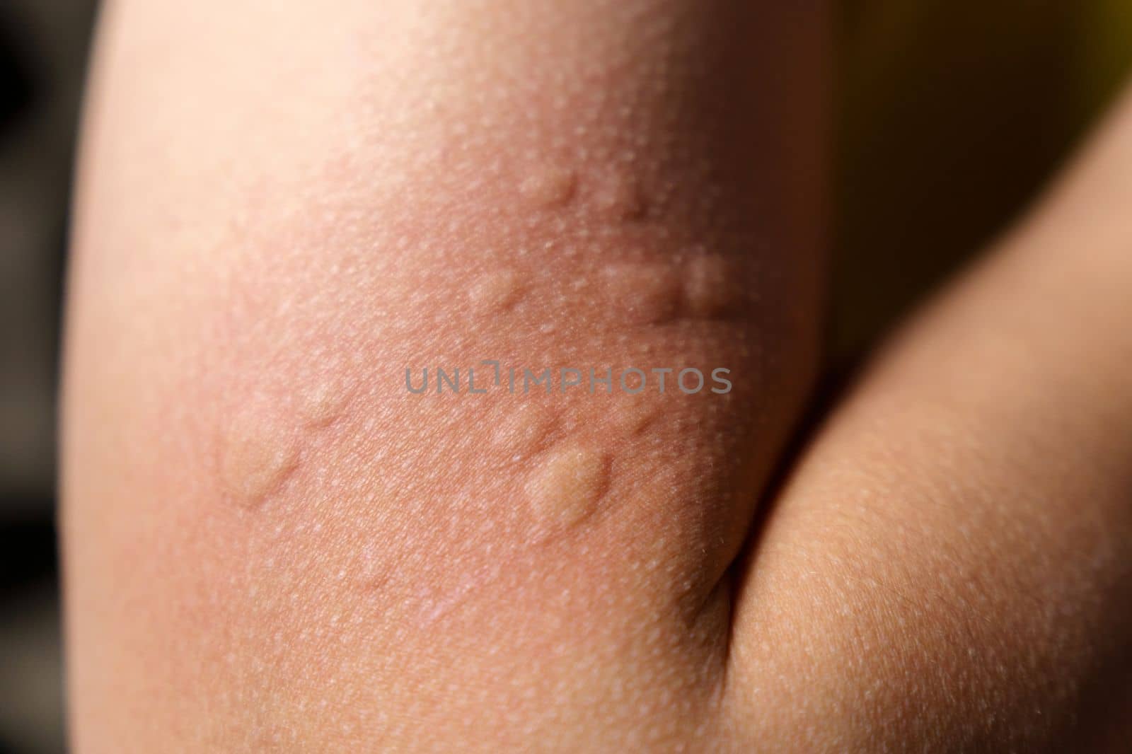 Allergy symptoms, after injection. Edematous part, red puncture site.