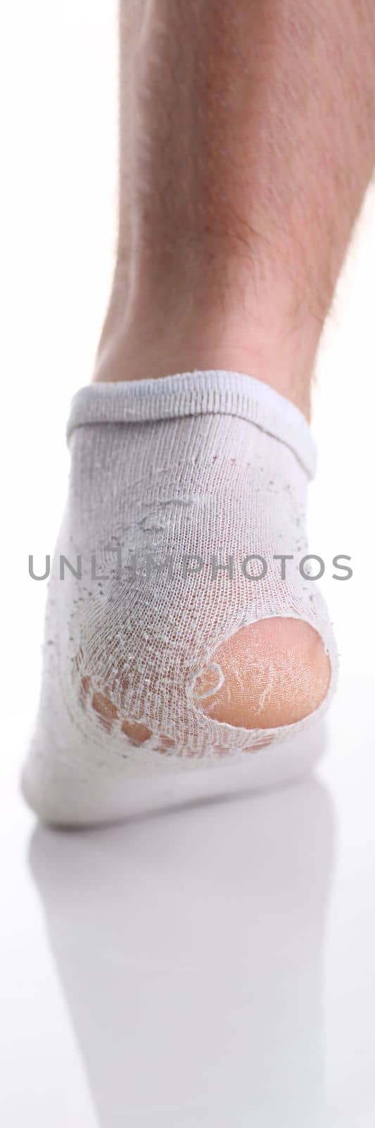 Torn white sock on man leg closeup. Poverty poverty and wear socks concept