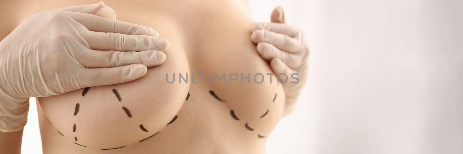 Woman with marks on chest for breast augmentation. Breast lift and augmentation concept