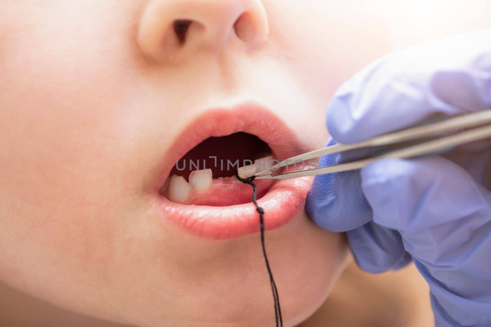 Extraction of a milk tooth in a child. Self-extraction of a tooth with a floss at home. Tie a floss to the tooth to extract it