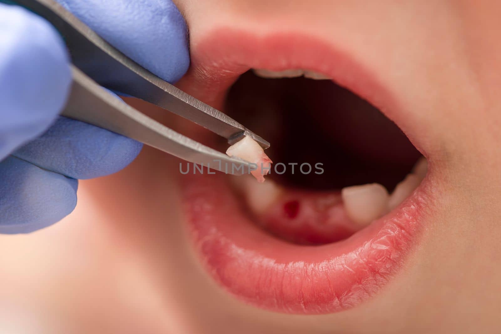 Removal of a milk tooth. The doctor pulled out a tooth from a child with tweezers. Extraction of a child's tooth with a dental instrument