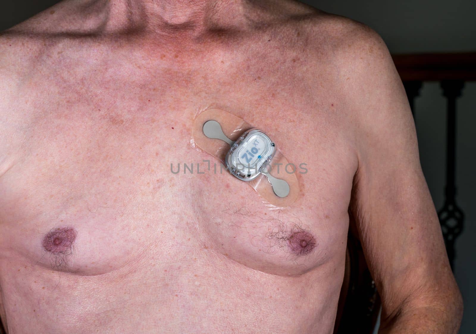 Morgantown, WV - 25 February 2023: Zio XT adhesive heart ECG monitor on male chest