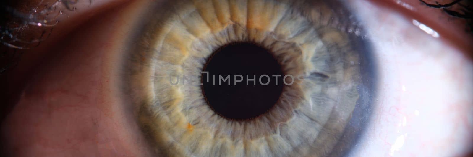 Inflamed reddened eye of girl closeup. Expansion of vessels of eye and tension from computer by kuprevich