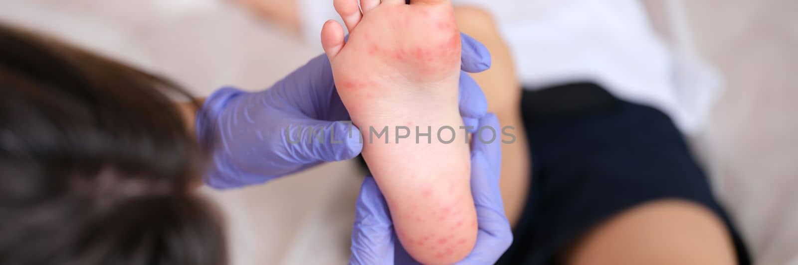 Doctor examines red rashes on feet of child closeup by kuprevich