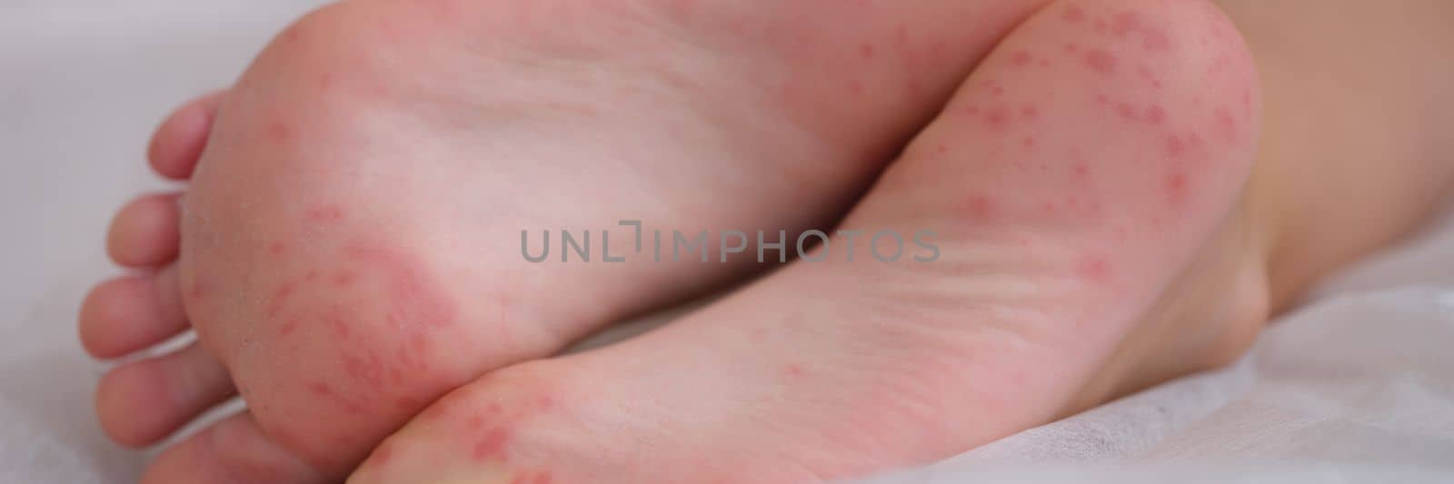 Children foot with dermatitis allergic rash. Closeup of child foot and toes with red rash and coxsackievirus enterovirus