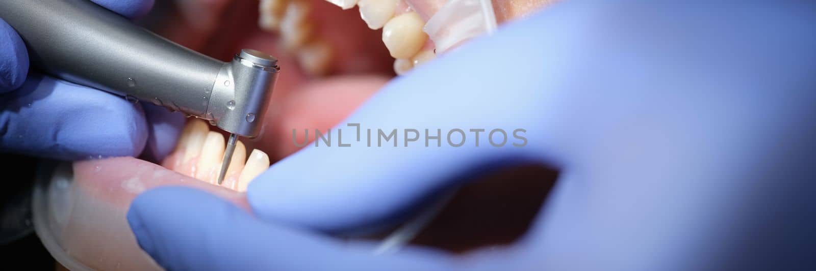 Dentist prepares woman teeth for the installation of ceramic veneers and crowns using drill by kuprevich