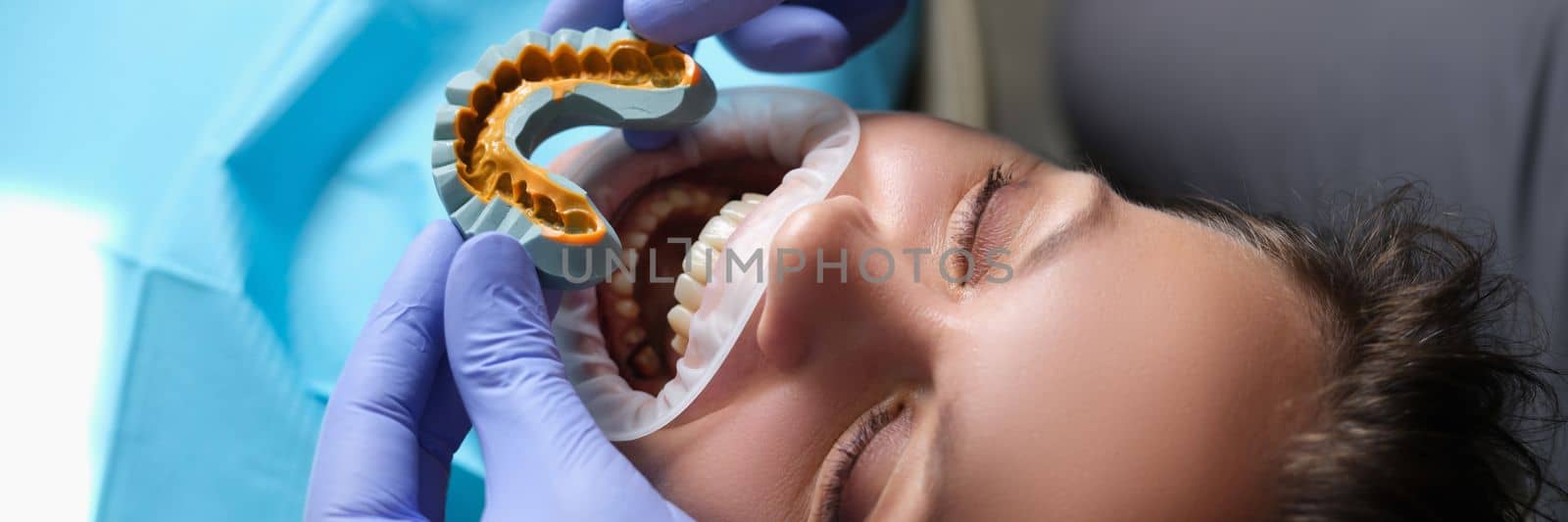 Simulation of artificial teeth on plaster model and patient with open mouth at dentist appointment. Preparing jaw for veneers concept