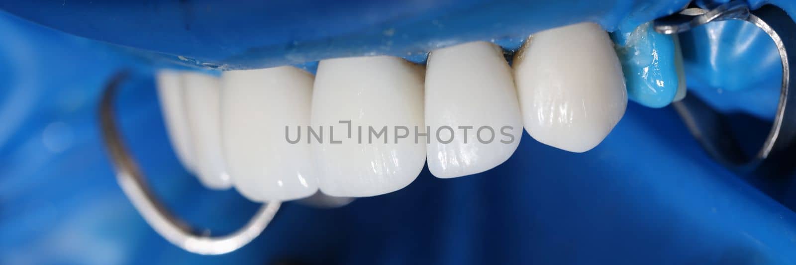 Installation of veneers and dental implants in clinic closeup by kuprevich