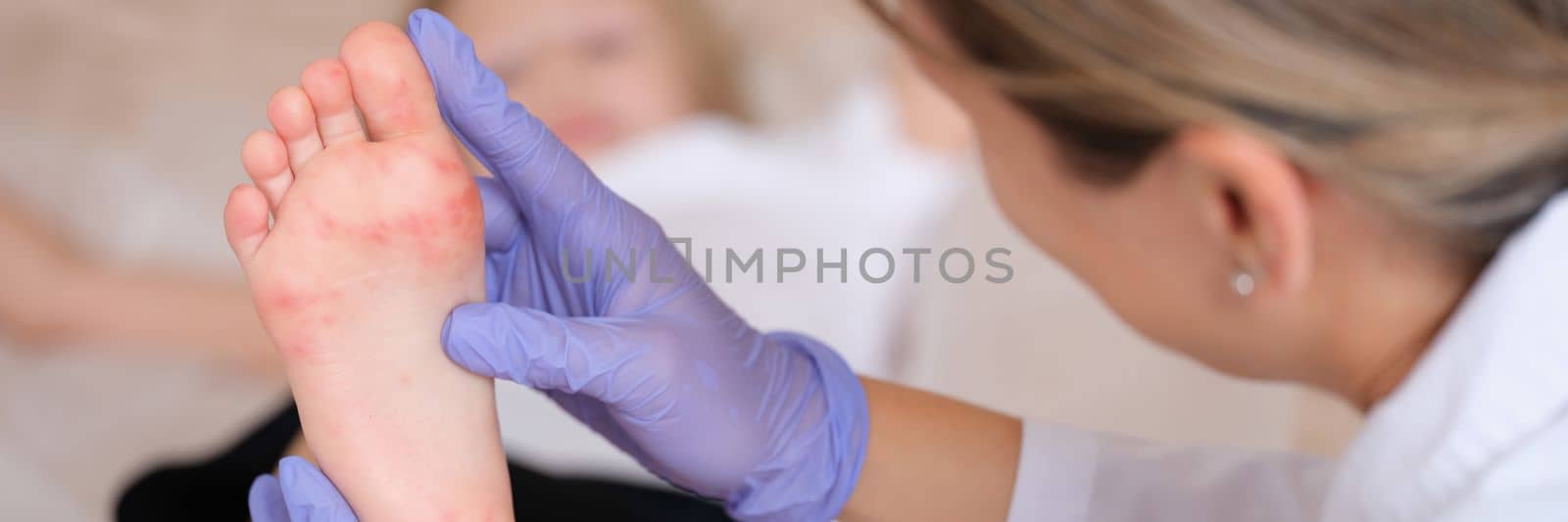 Doctor conducts medical examination of leg of child with red itchy rash closeup by kuprevich