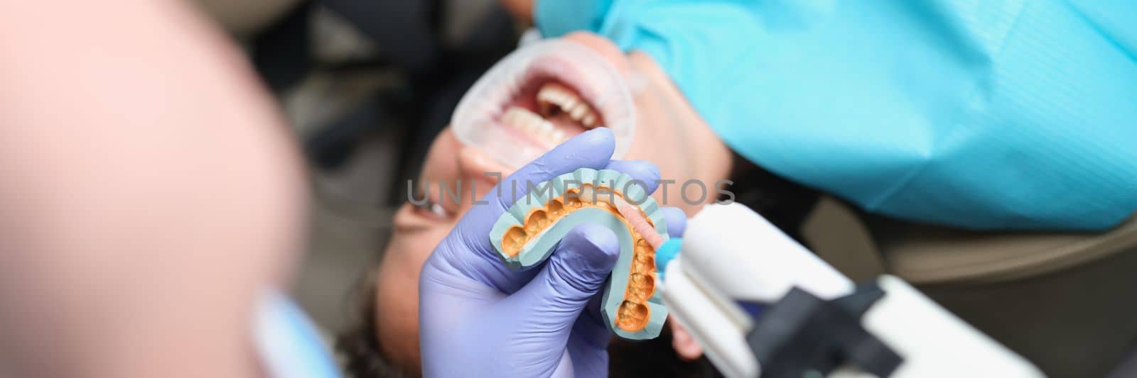 Removal of casts for the manufacture of veneers. Dentist is holding cast for dental veneers in hands.