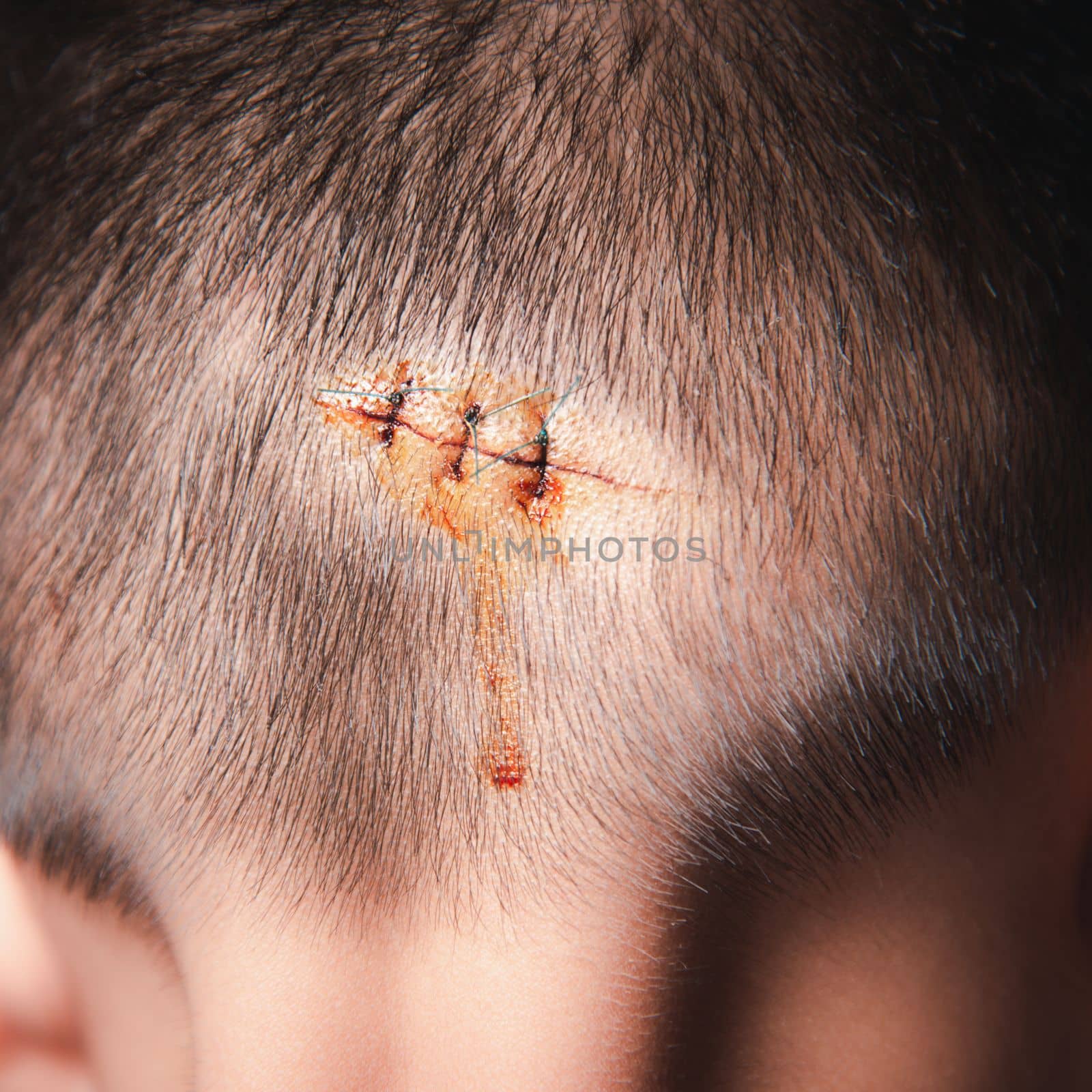 The lacerated sutured wound of kid back head which suture by nylon suture about 3 stitches at the emergency room of the hospital, Medical care of the surgery lesion on the head, children of Accident