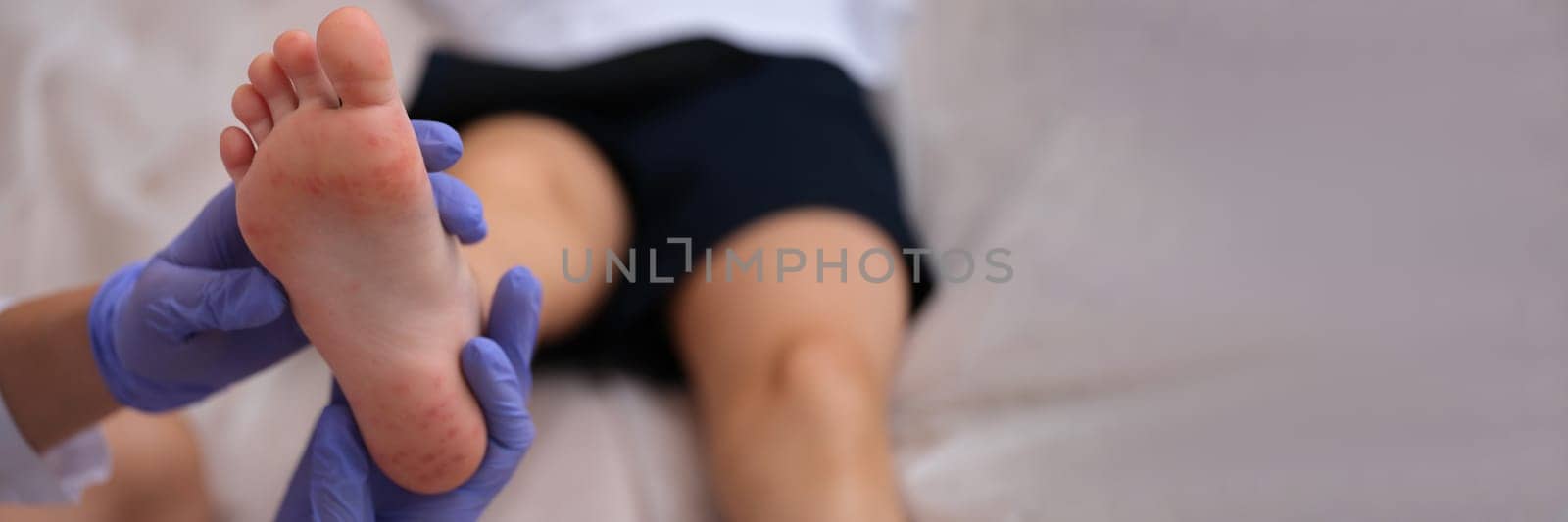 Infectious disease doctor examining rash on skin of child feet closeup by kuprevich