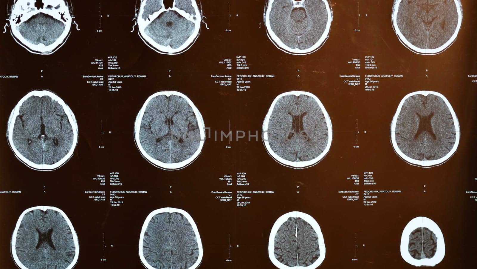 Magnetic resonance imaging, MRI of human brain after traumatic head injury, stroke, illness in elderly man in hospital. Examination by a neurologist