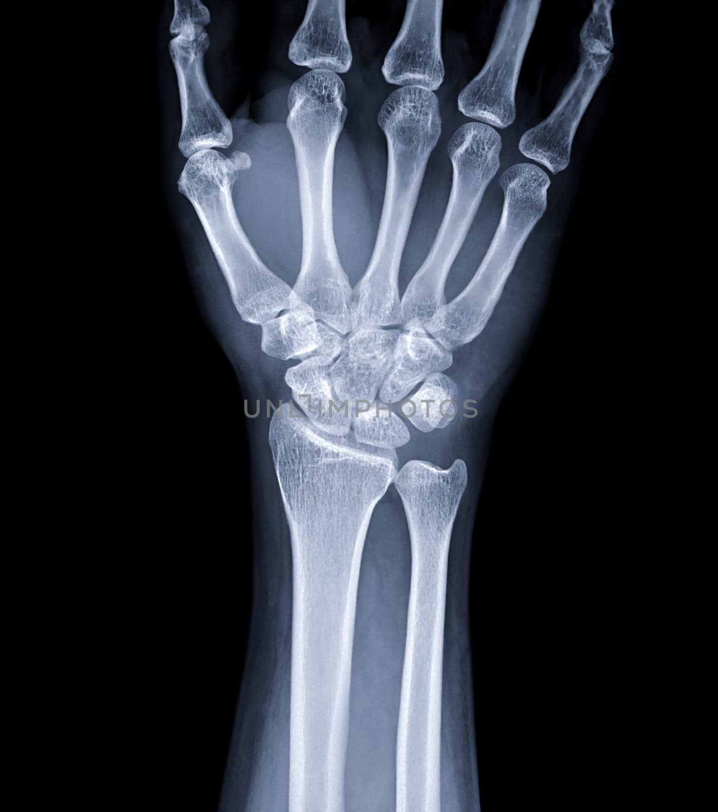 X-ray image of wrist joint for diagnosis rheumatoid arthritis . by samunella